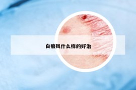 白癜风什么样的好治