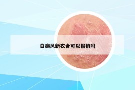 白癜风新农合可以报销吗