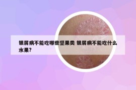 银屑病不能吃哪些坚果类 银屑病不能吃什么水果?