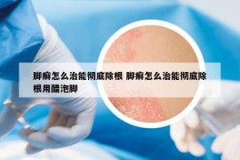 脚癣怎么治能彻底除根 脚癣怎么治能彻底除根用醋泡脚