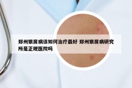 郑州银屑病该如何治疗最好 郑州银屑病研究所是正规医院吗