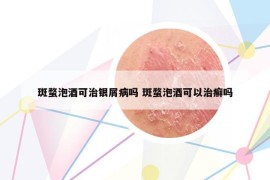 斑蝥泡酒可治银屑病吗 斑蝥泡酒可以治癣吗