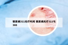 银屑病311光疗时间 银屑病光疗311与308