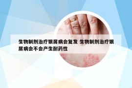 生物制剂治疗银屑病会复发 生物制剂治疗银屑病会不会产生耐药性