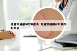 儿童银屑病可以断根吗 儿童银屑病可以断根吗知乎