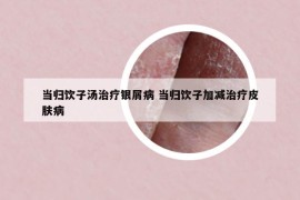 当归饮子汤治疗银屑病 当归饮子加减治疗皮肤病