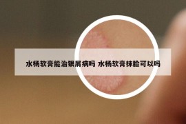 水杨软膏能治银屑病吗 水杨软膏抹脸可以吗