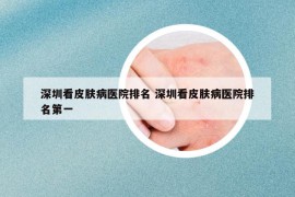 深圳看皮肤病医院排名 深圳看皮肤病医院排名第一