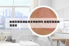 脓疱型银屑病能用生物制剂吗 脓疱型银屑病用激素