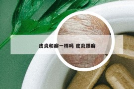 皮炎和癣一样吗 皮炎跟癣