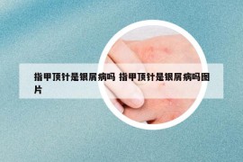 指甲顶针是银屑病吗 指甲顶针是银屑病吗图片