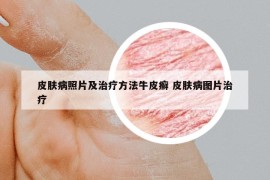 皮肤病照片及治疗方法牛皮癣 皮肤病图片治疗