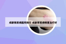 成都银屑病医院排行 成都银屑病哪里治疗好