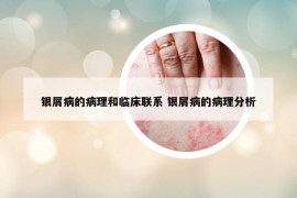 银屑病的病理和临床联系 银屑病的病理分析