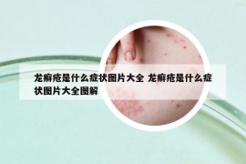 龙癣疮是什么症状图片大全 龙癣疮是什么症状图片大全图解