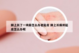 脚上长了一块藓怎么办老起皮 脚上长癣并起皮怎么办呢