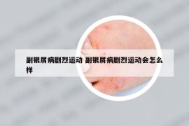 副银屑病剧烈运动 副银屑病剧烈运动会怎么样