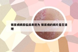 银屑病鳞屑临床表现为 银屑病的鳞片是否清理