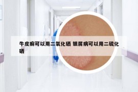 牛皮癣可以用二氧化硒 银屑病可以用二硫化硒