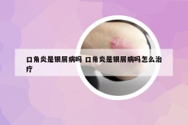 口角炎是银屑病吗 口角炎是银屑病吗怎么治疗