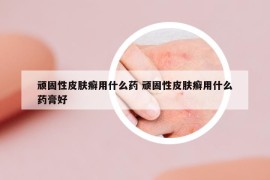 顽固性皮肤癣用什么药 顽固性皮肤癣用什么药膏好