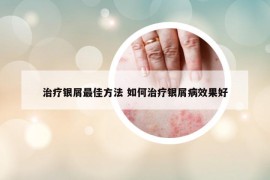 治疗银屑最佳方法 如何治疗银屑病效果好