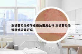 消银颗粒治疗牛皮癣效果怎么样 消银颗粒治银屑病效果好吗