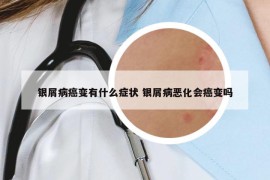 银屑病癌变有什么症状 银屑病恶化会癌变吗