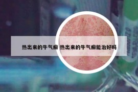 热出来的牛气癣 热出来的牛气癣能治好吗