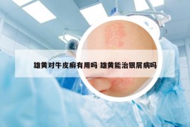 雄黄对牛皮癣有用吗 雄黄能治银屑病吗