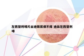 左西替利嗪片皿迪银屑病不痒 迪血左西替利嗪