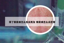 得了银屑病怎么告诉男友 银屑病怎么谈恋爱