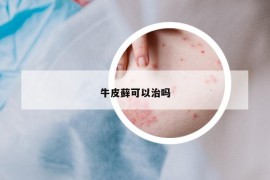 牛皮藓可以治吗