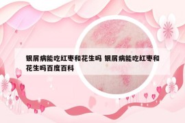 银屑病能吃红枣和花生吗 银屑病能吃红枣和花生吗百度百科