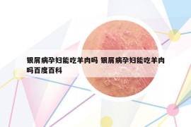 银屑病孕妇能吃羊肉吗 银屑病孕妇能吃羊肉吗百度百科