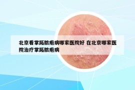 北京看掌跖脓疱病哪家医院好 在北京哪家医院治疗掌跖脓疱病