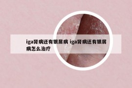 iga肾病还有银屑病 iga肾病还有银屑病怎么治疗