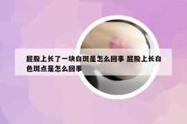 屁股上长了一块白斑是怎么回事 屁股上长白色斑点是怎么回事