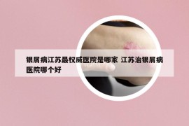 银屑病江苏最权威医院是哪家 江苏治银屑病医院哪个好