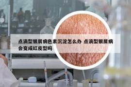 点滴型银屑病色素沉淀怎么办 点滴型银屑病会变成红皮型吗