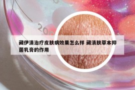 藏伊清治疗皮肤病效果怎么样 藏清肤草本抑菌乳膏的作用