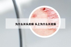 为什么长头皮癣 头上为什么长皮癣