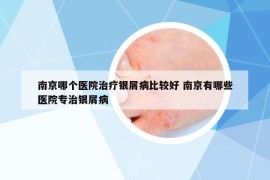 南京哪个医院治疗银屑病比较好 南京有哪些医院专治银屑病