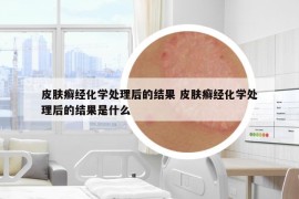 皮肤癣经化学处理后的结果 皮肤癣经化学处理后的结果是什么