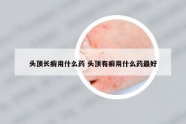 头顶长癣用什么药 头顶有癣用什么药最好