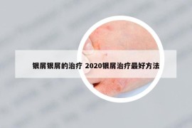 银屑银屑的治疗 2020银屑治疗最好方法