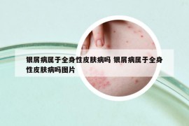 银屑病属于全身性皮肤病吗 银屑病属于全身性皮肤病吗图片