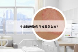 牛皮酸传染吗 牛皮酸怎么治?