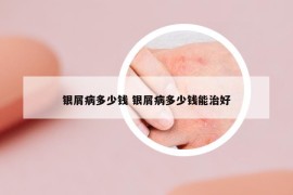 银屑病多少钱 银屑病多少钱能治好