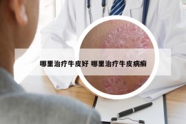 哪里治疗牛皮好 哪里治疗牛皮病癣